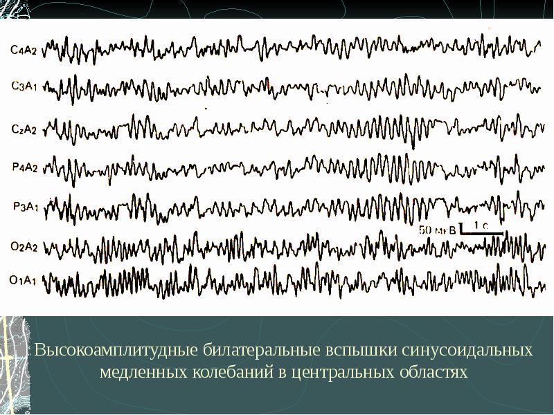 Билатерально синхронная вспышка