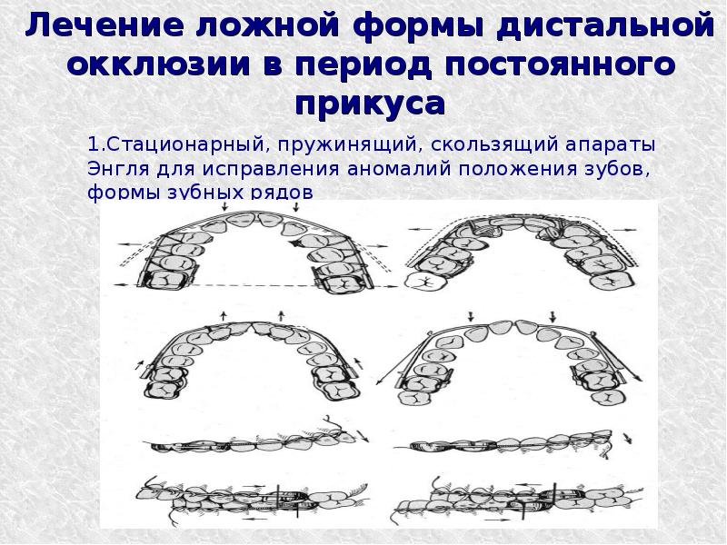 Лечение дистальной окклюзии. Форма зубных рядов в постоянном прикусе. Аппарат Персина для дистальной окклюзии. Формы дистальной окклюзии. Аппарат Персина для лечения дистальной окклюзии.