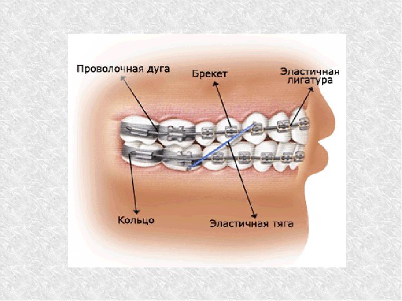 Брекет системы проект