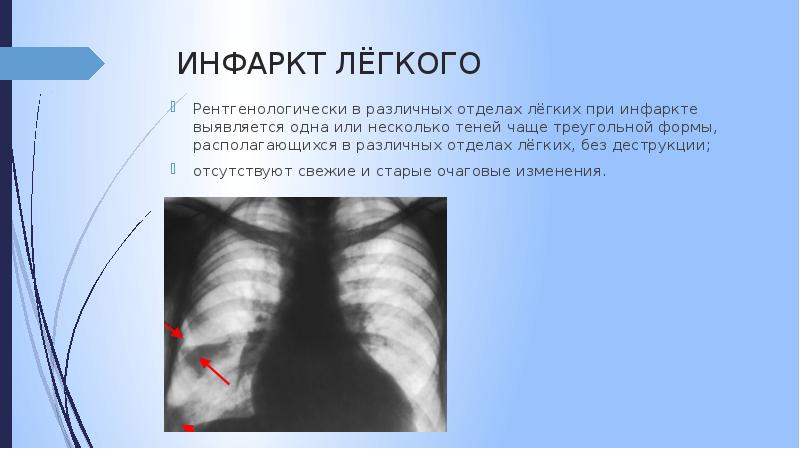 Очаговые изменения в легких презентация