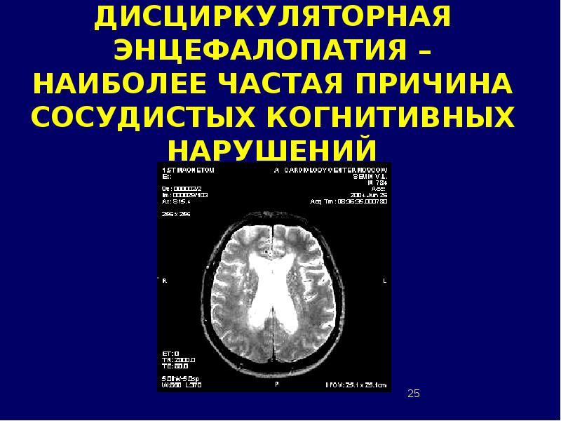 Дисциркуляторные изменения головного мозга что это такое. Дисциркуляторная энцефалопатия. Дисциркуляторная энцефалопатия на кт. Профилактика дисциркуляторной энцефалопатии. Клиника дисциркуляторной энцефалопатии.