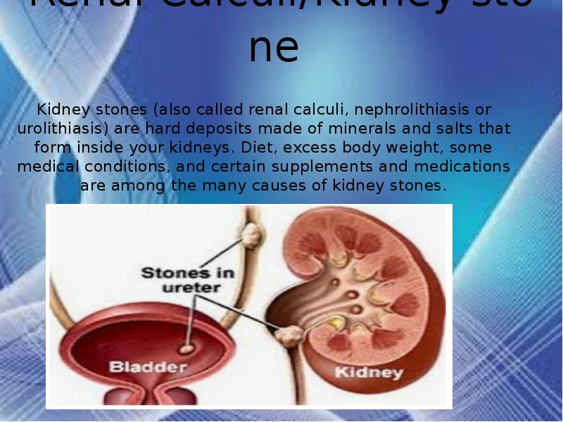 Операция pbs percutaneous bianchi system. Nephrolithiasis латынь. Urolithiasis pictures. Почечно-каменная болезнь. Инфламмасома.