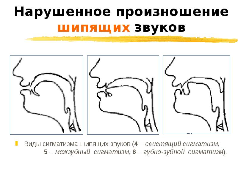 Нарушения свистящих и шипящих звуков