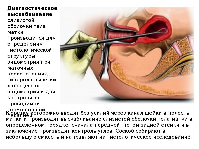 Выскабливание. Хирургическое выскабливание полости матки. Диагностическое выскабливание слизистой оболочки матки. Диагностическое выскабливание матки (показания, инструментарий). Малые операции в гинекологии.