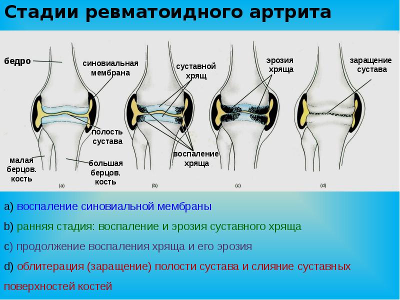 Артрит презентация қазақша