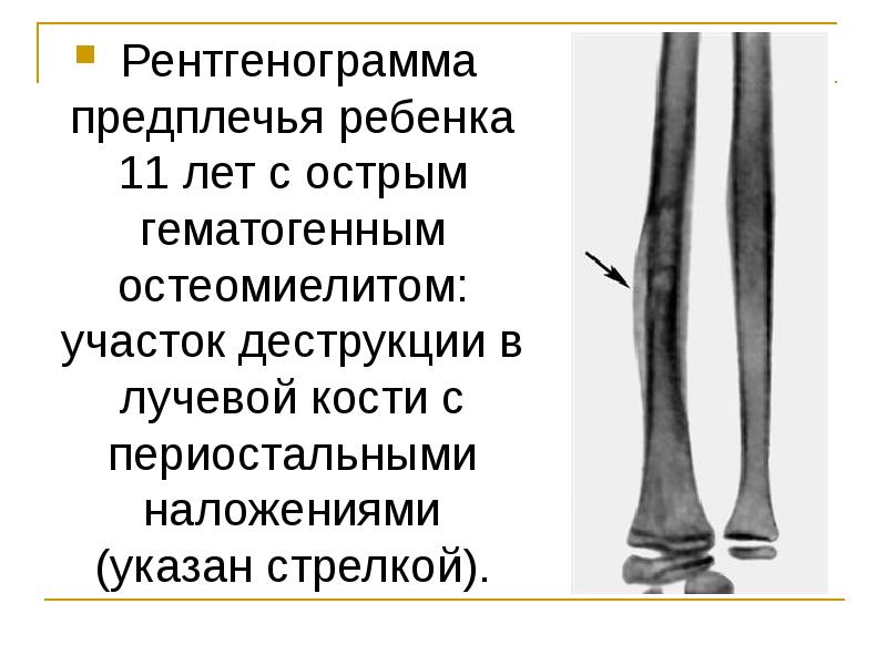 Остеомиелит у детей презентация