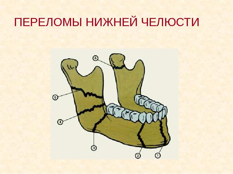 Переломы челюстей стоматология презентация