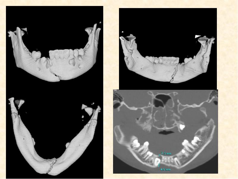 Переломы нижней челюсти стоматология презентация