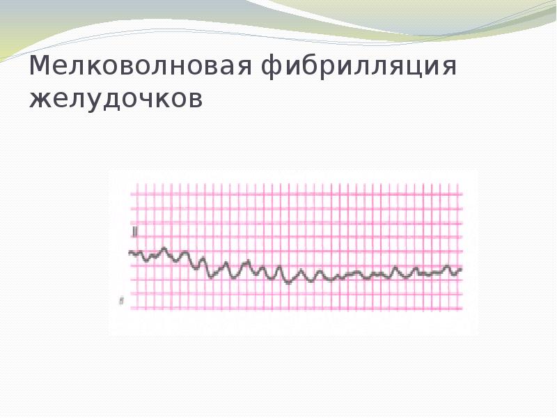 Фибрилляция желудочков на экг картинки