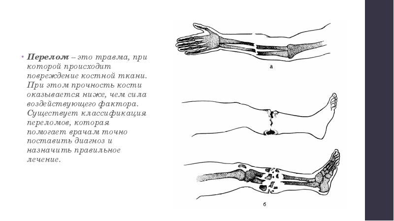 Переломы обж 7 класс презентация