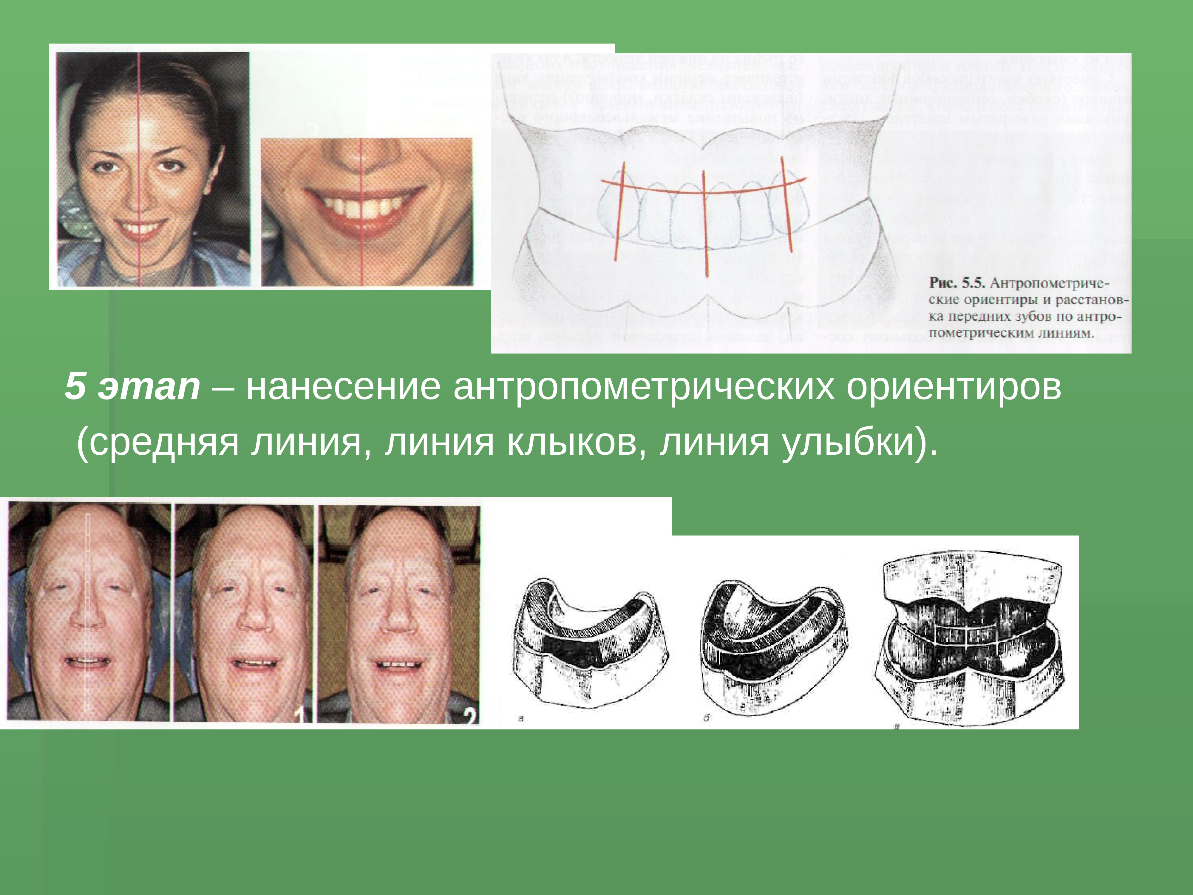 Линия челюсти. Антропометрические ориентиры на окклюзионных валиках. Центральное соотношение челюстей. Определить центральное соотношение челюстей. Центральное соотношение челюстей при полном отсутствии зубов.
