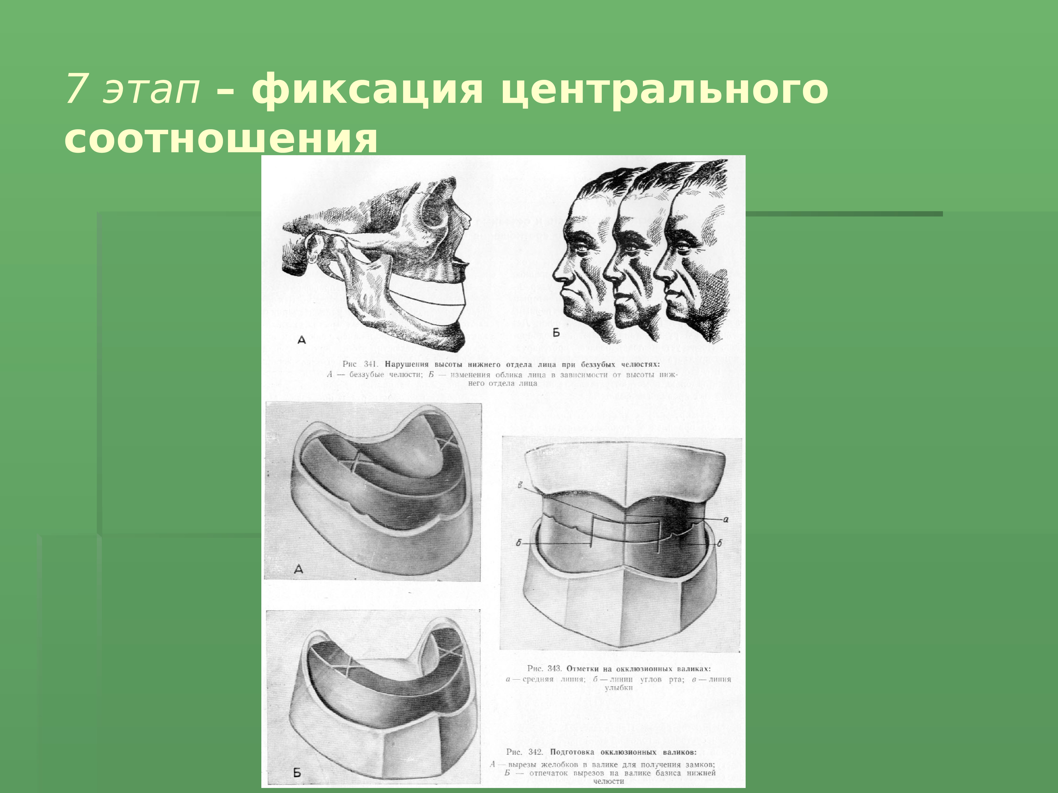 Этапы определение центрального соотношения. Фиксация центрального соотношения челюстей. Центральное соотношение челюстей. Этапы определения центрального соотношения челюстей. Фиксация центрального соотношения беззубых челюстей.