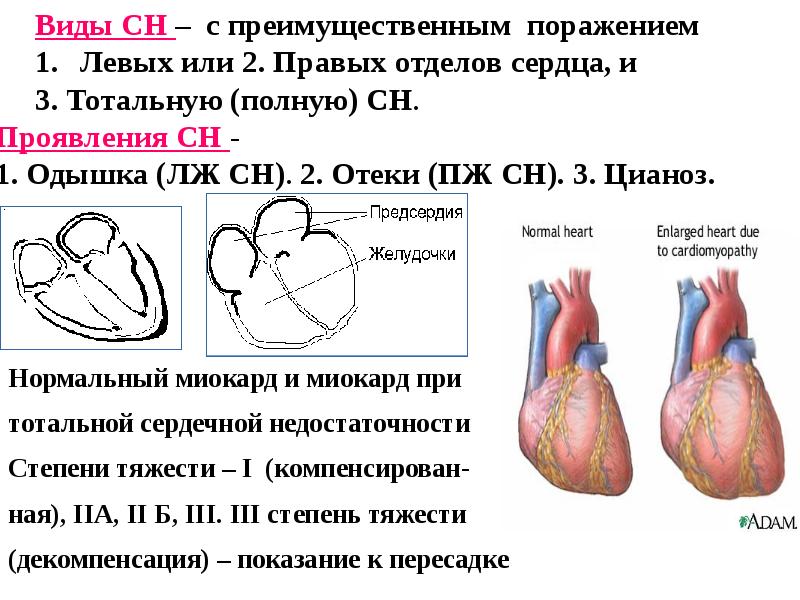 Преимущественное поражение сердца без застойной сердечной. Базальные отделы сердца. Правые отделы сердца и левые. Апикальный отдел сердца. Инфаркт миокарда базальных отделов сердца.