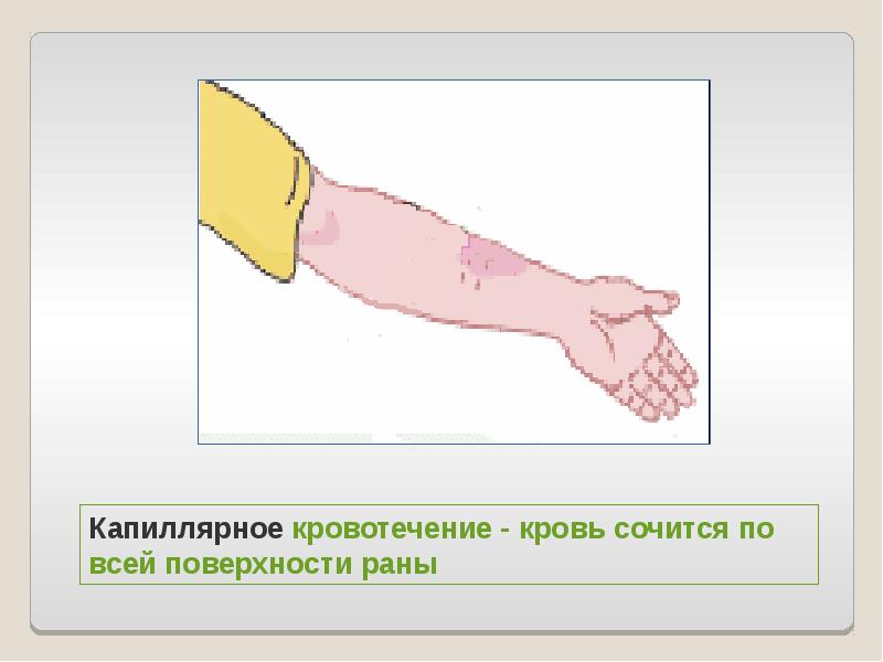 Капиллярное кровотечение первая помощь картинки