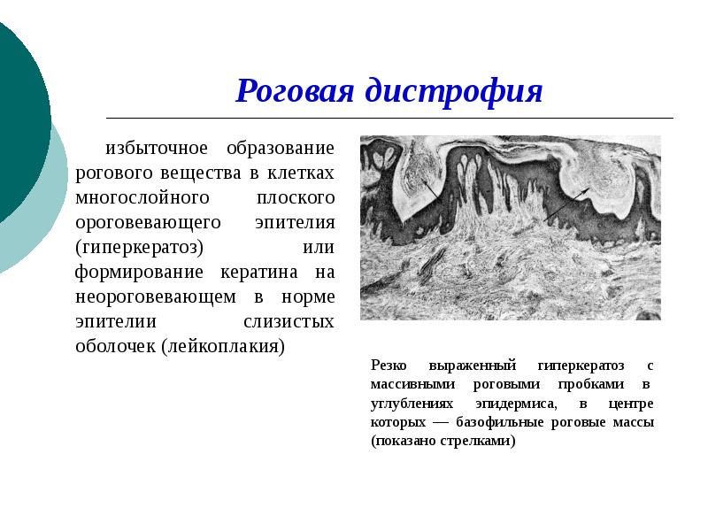 Роговая дистрофия. Роговая дистрофия лейкоплакия. Роговая дистрофия многослойного плоского ороговевающего эпителия. Роговое вещество.