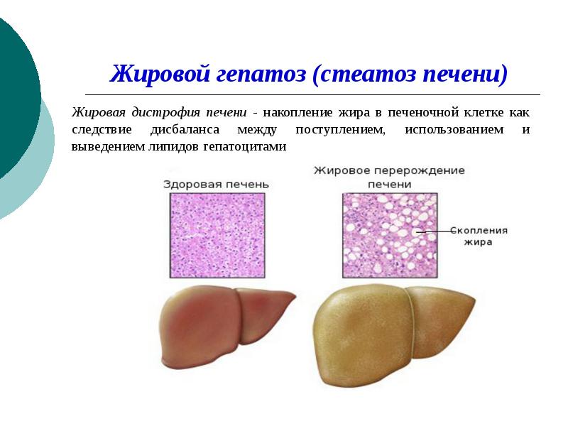 Симптомы жирового гепатоза печени