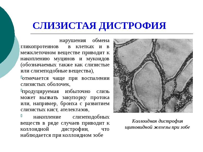 Роговая дистрофия. Слизистая дистрофия эпителия бронха. Слизистая дистрофия эпикарда. Внеклеточная слизистая дистрофия. Паренхиматозная слизистая дистрофия.