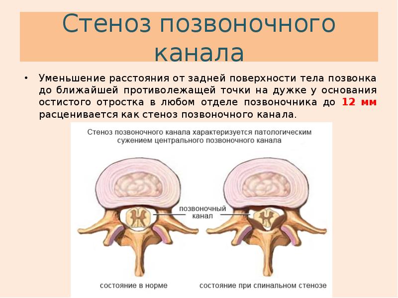 Стеноз позвоночного канала поясничного отдела в картинках