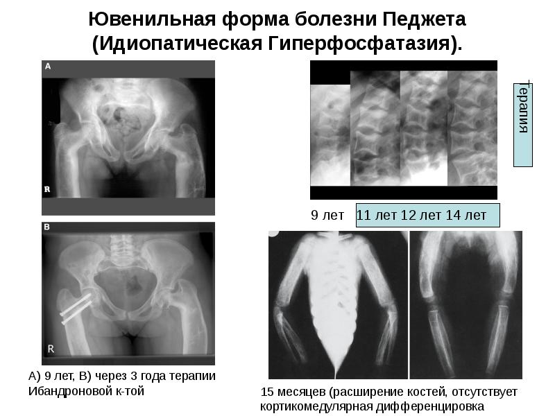 Болезнь педжета презентация