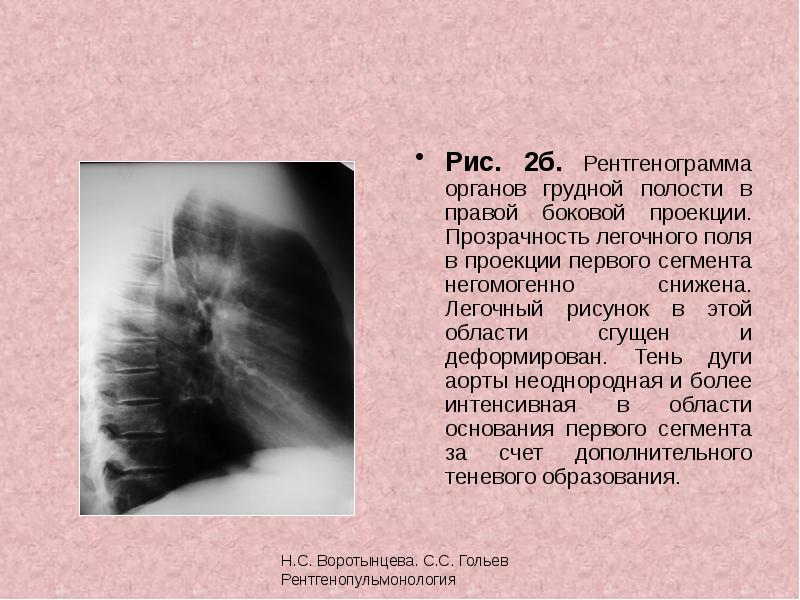 Корни тяжистые легочный рисунок деформирован