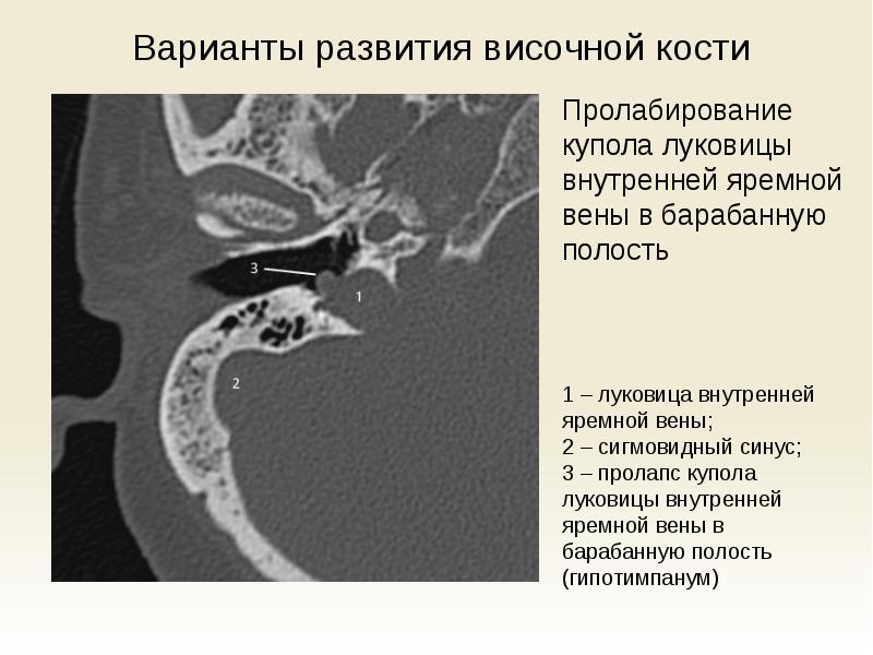 С какой стенкой барабанной полости граничит луковица яремной вены