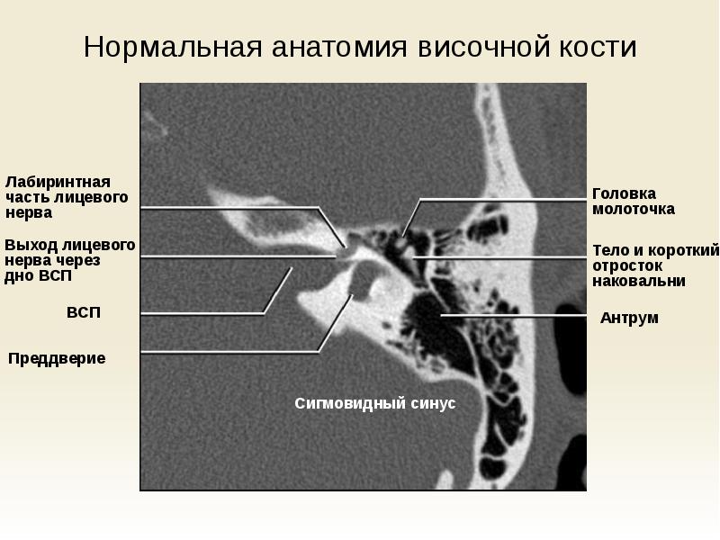 Средний отит кт картина