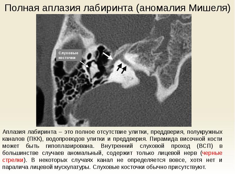 Аномалии развития уха презентация