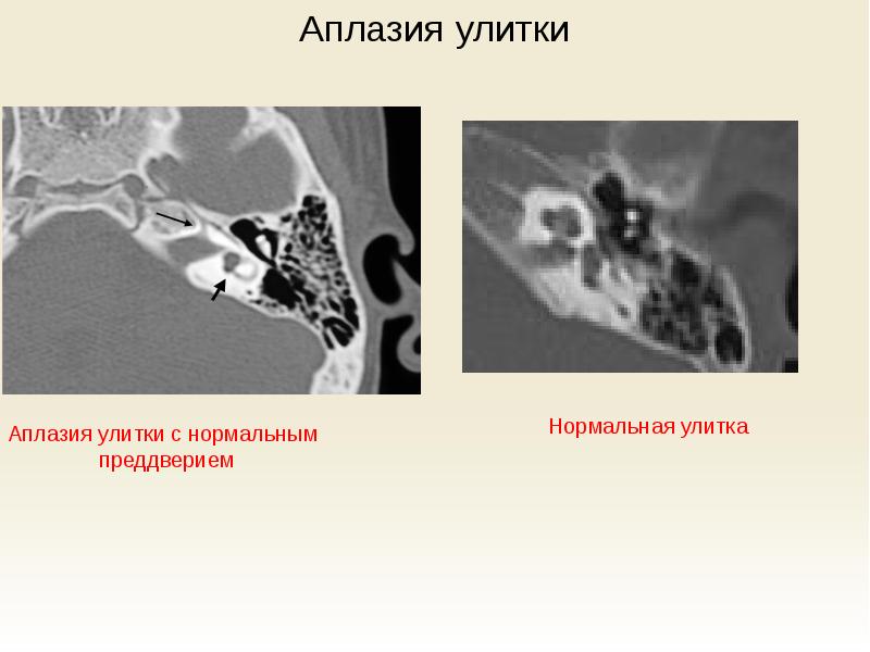 Аплазия это в медицине. Аплазия улитки внутреннего уха. Аномалии внутреннего уха кт. Аплазия улитки внутреннего уха кт. Внутреннее ухо кт.