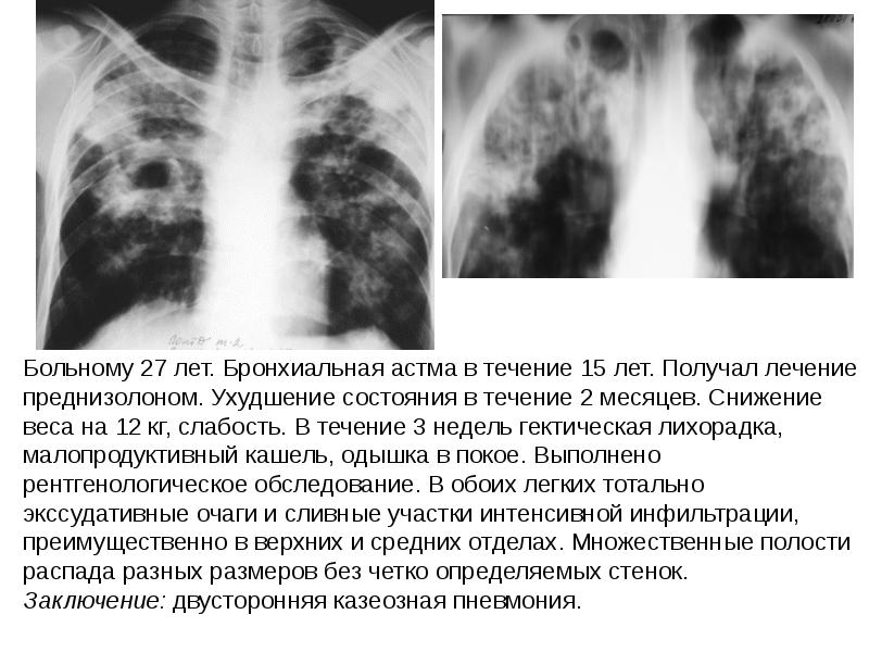 Бронхиальная астма рентгенологическая картина