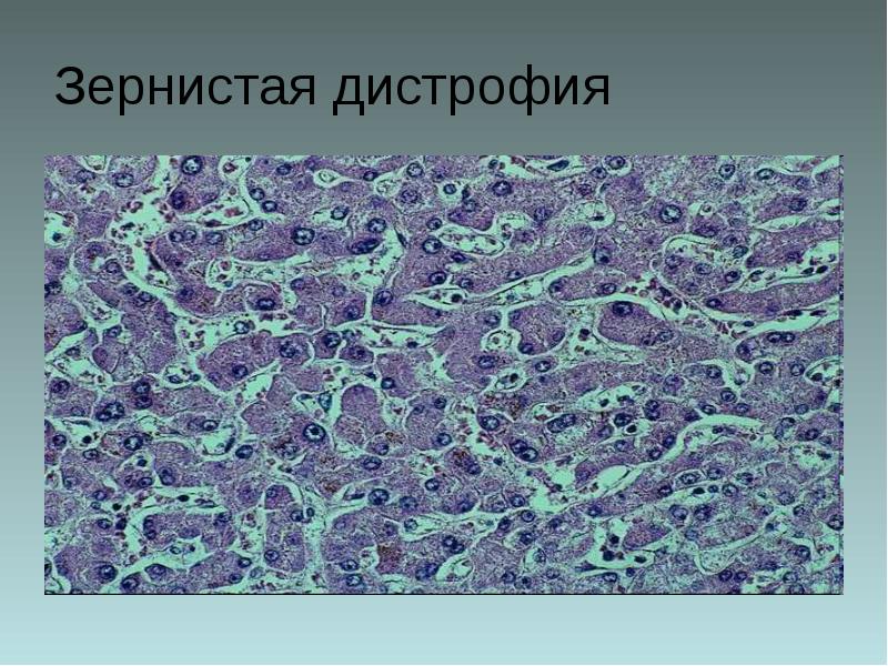 Подпишите виды дистрофий рисунки