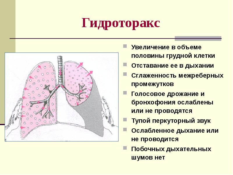 Пневмонии пропедевтика внутренних болезней презентация