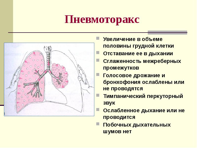 Пневмонии пропедевтика внутренних болезней презентация