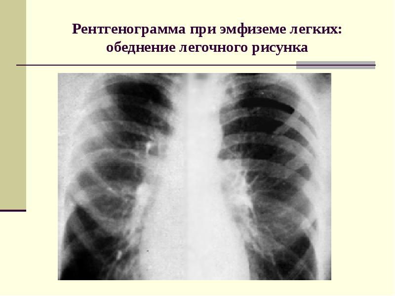 Рентгенография грудной клетки — Википедия