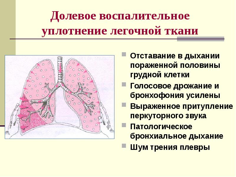 Пневмонии пропедевтика внутренних болезней презентация - 84 фото