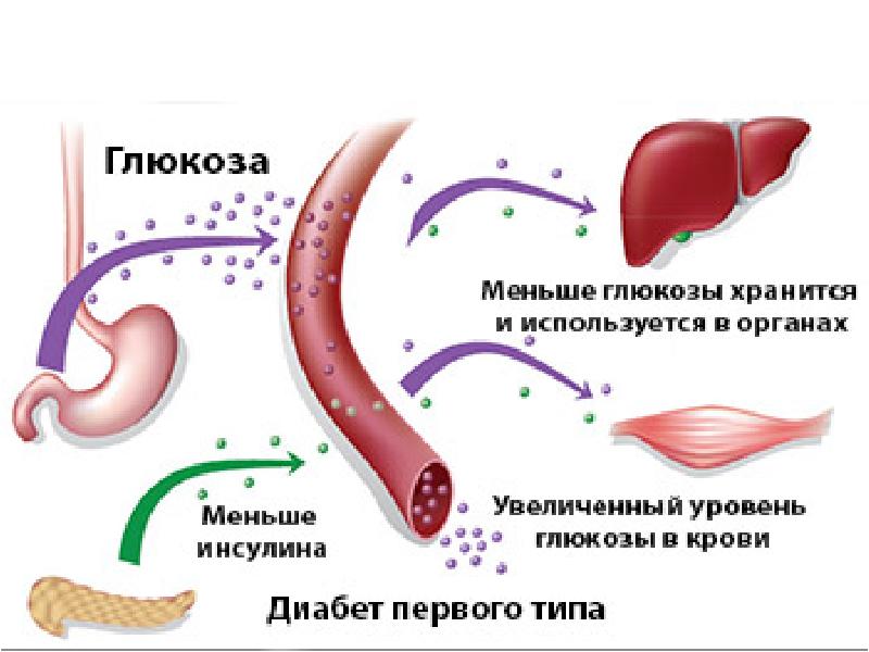 Механизм диабета 1 типа. Сахарный диабет 1 типа характеризуется. СД 1 типа. СД 1 типа инсулин. Инсулинзависимый сахарный диабет Тип.