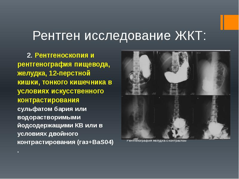 Рентгенологическое исследование тонкой кишки