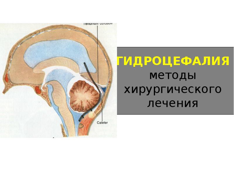 Гидроцефалия как лечить. Гидроцефалия головного мозга. Гидроцефалия спинного мозга. Гидроцефалия презентация. Наружная гипотрофическая гидроцефалия головного мозга у взрослых.