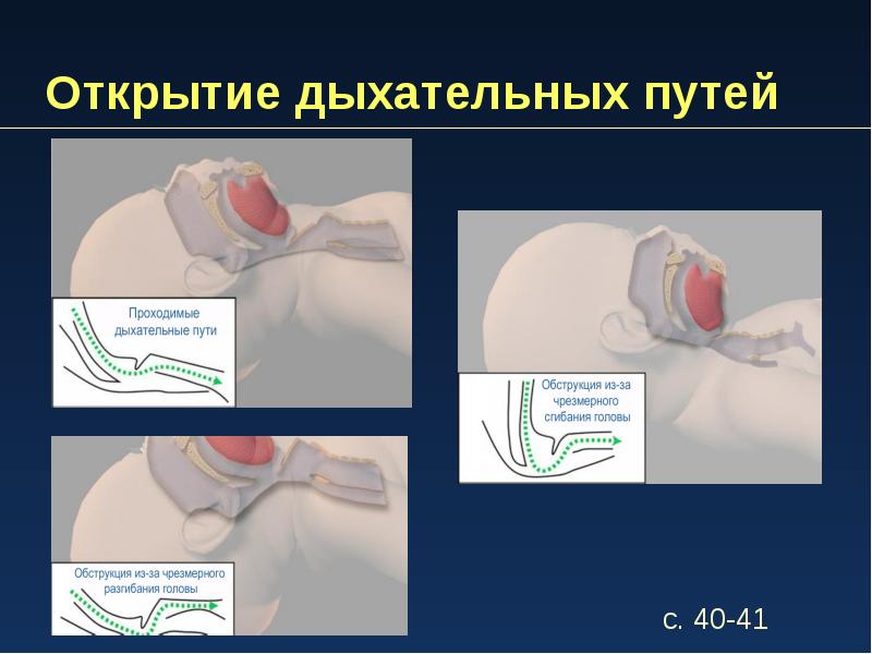 Для открытия дыхательных путей. Открытие дыхательных путей. Способы открытия дыхательных путей. Опишите метод открытия дыхательных путей. 2 Метода открытия дыхательных путей.