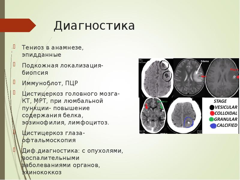 Диагностика Тениоз в анамнезе, эпидданные Подкожная локализация- биопсия Иммуноблот, ПЦР Цистицеркоз