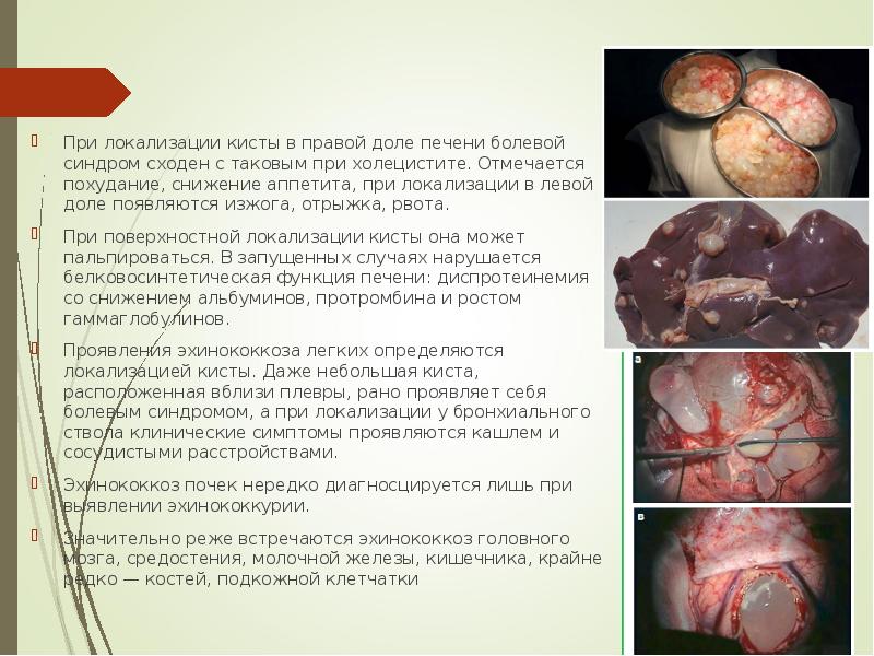При локализации кисты в правой доле печени болевой синдром сходен с
