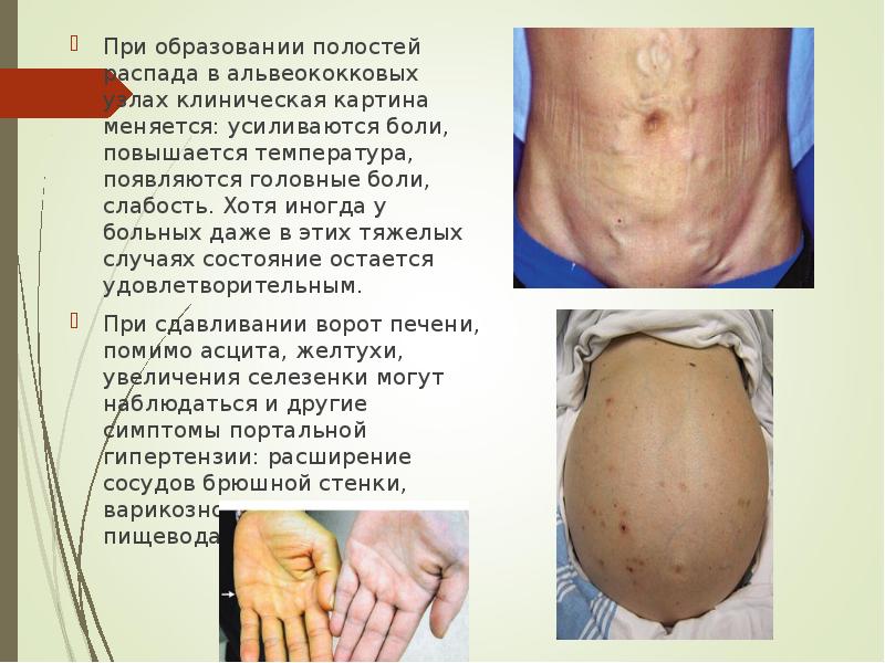 При образовании полостей распада в альвеококковых узлах клиническая картина меняется: усиливаются