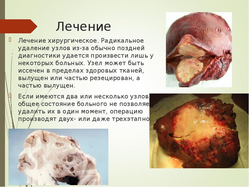 Лечение Лечение хирургическое. Радикальное удаление узлов из-за обычно поздней диагностики удается