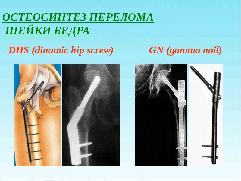 Переломы проксимального отдела бедренной кости презентация