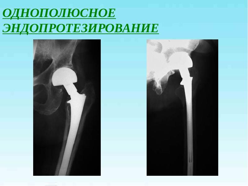 Перелом бедренной кости презентация