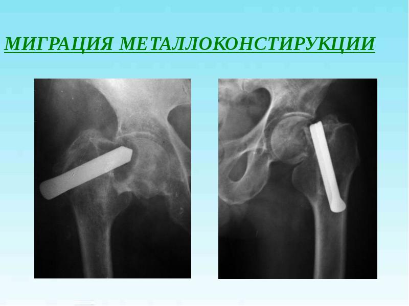 Переломы проксимального отдела бедренной кости презентация