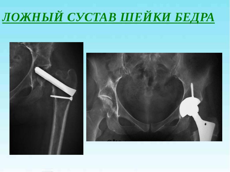 Переломы проксимального отдела бедренной кости презентация