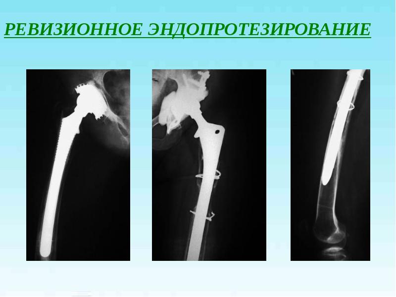 Переломы проксимального отдела бедренной кости презентация