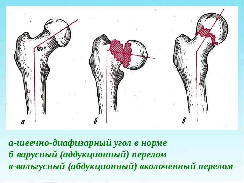 Перелом бедренной кости презентация