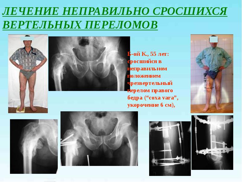 Переломы проксимального отдела бедренной кости презентация