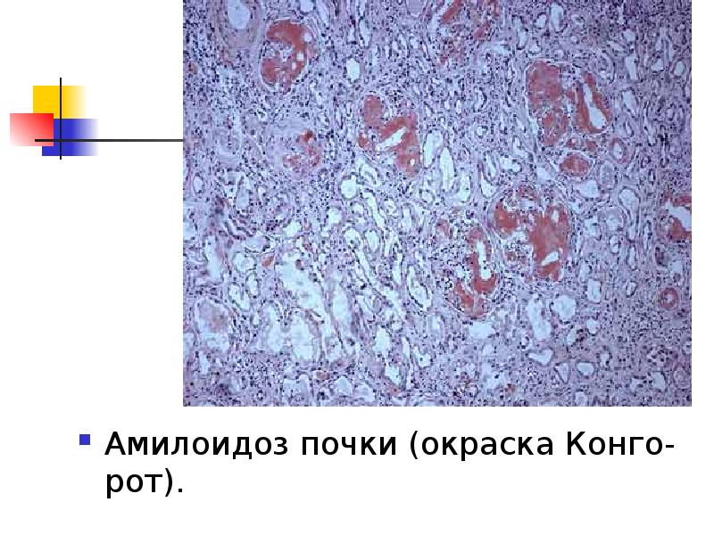 Амилоидоз презентация по терапии